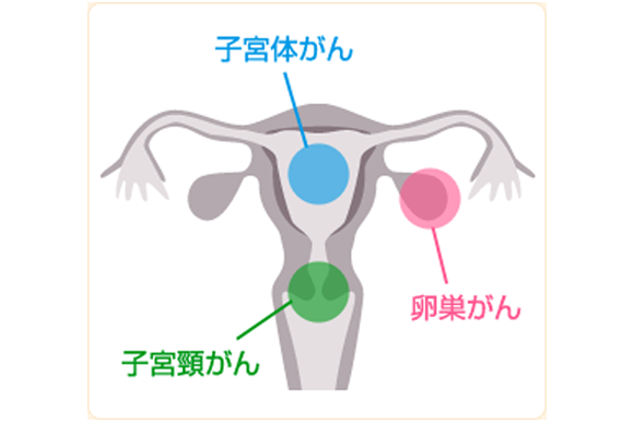 がんの種類
